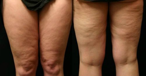 Lipedema, a síndrome das pernas gordas