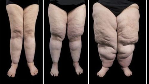Lipedema, a síndrome das pernas gordas